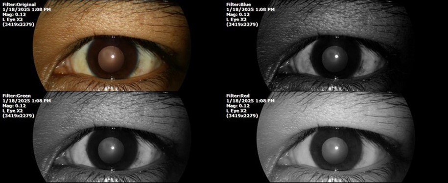 The photograph of the left eye does not show pathological data.